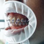 Metal braces and pink ligatures for orthodontic treatment at Dreamwork Dental