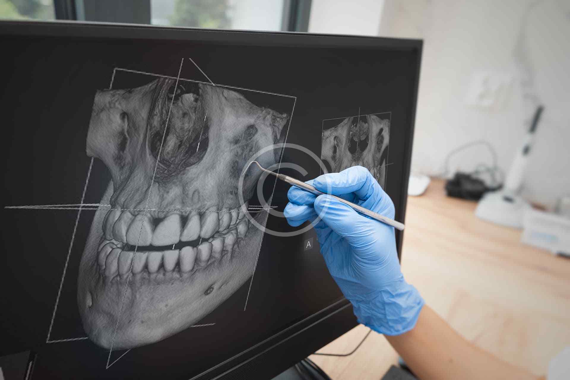 Root Canal Treatment
